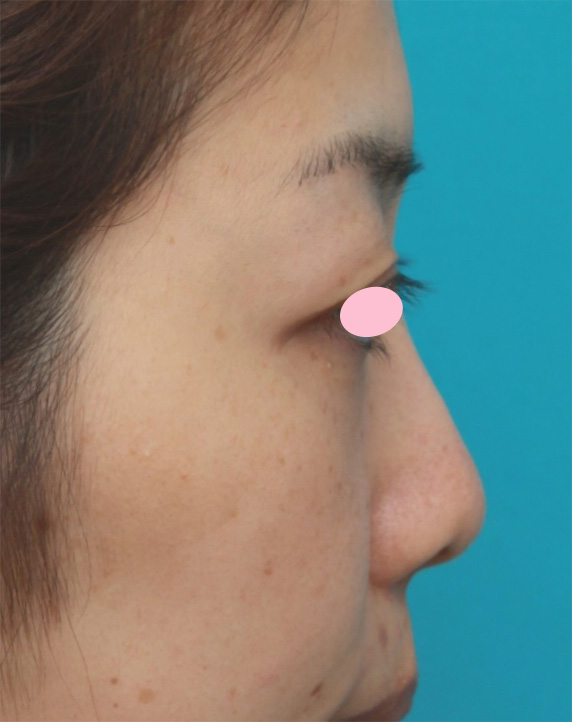 耳介軟骨移植（鼻先を出す）,耳介軟骨移植で丸い鼻先を斜め下方向に綺麗に出した20代女性の症例写真の術前術後画像,Before,ba_jikai43_b.jpg