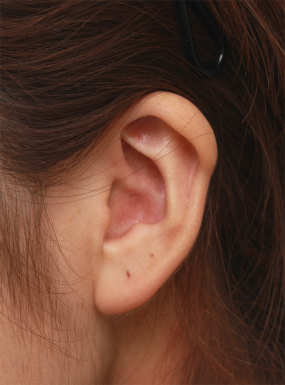 耳介軟骨移植（鼻先を出す）,耳介軟骨移植で丸い鼻先を斜め下方向に綺麗に出した20代女性の症例写真の術前術後画像,After（6ヶ月後）,ba_jikai44_b.jpg