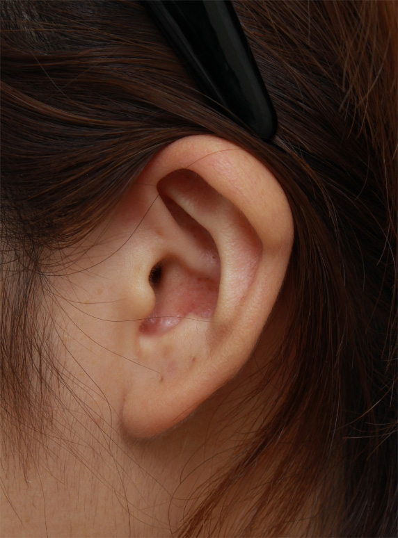 耳介軟骨移植（鼻先を出す）,耳介軟骨移植で丸い鼻先を斜め下方向に綺麗に出した20代女性の症例写真の術前術後画像,Before,ba_jikai44_b.jpg