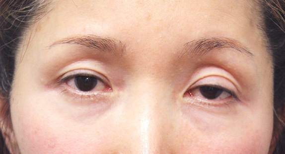 眼瞼下垂（がんけんかすい） 腱膜性眼瞼下垂の50代女性の症例,Before,ba_ganken31_b.jpg