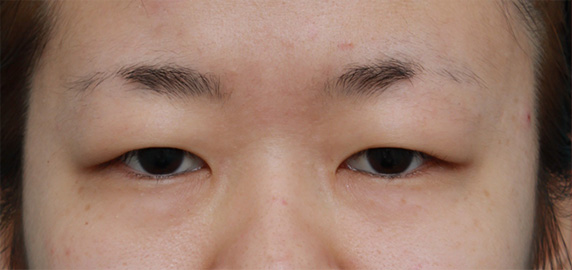 症例写真,非常に厚ぼったい一重まぶたに対して、大量の脂肪を切除して眼瞼下垂手術を行った症例写真,Before,ba_ganken38_b.jpg