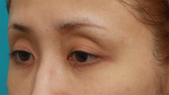 症例写真,眼瞼下垂手術をして、まぶたの窪みを解消させ、二重を作った症例写真,Before,ba_ganken41_b.jpg