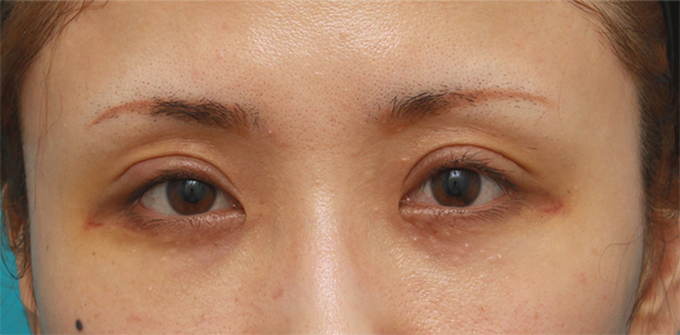 症例写真,眼瞼下垂手術をして、まぶたの窪みを解消させ、二重を作った症例写真,1週間後,mainpic_ganken07c.jpg