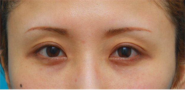 症例写真,眼瞼下垂手術をして、まぶたの窪みを解消させ、二重を作った症例写真,6ヶ月後,mainpic_ganken07d.jpg
