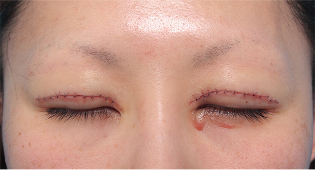 症例写真,他院で行われた二重まぶた切開法に対し、眼瞼下垂手術で二重の幅を狭く修正した症例写真,手術直後,mainpic_ganken08f.jpg