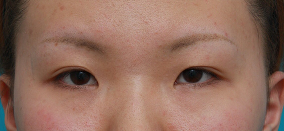 目頭切開+眼瞼下垂手術の症例写真,Before,ba_ganken44_b.jpg