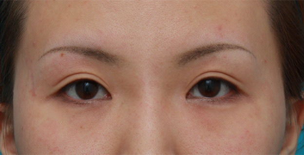 症例写真,目頭切開+眼瞼下垂手術の症例写真,6ヶ月後,メイクなし,mainpic_ganken09e.jpg