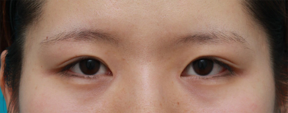 症例写真,目頭切開+眼瞼下垂手術で小さい目を一回り大きくした症例写真,After,ba_ganken45_b.jpg