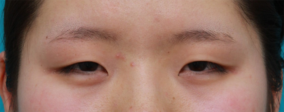 症例写真,目頭切開+眼瞼下垂手術で小さい目を一回り大きくした症例写真,Before,ba_ganken45_b.jpg