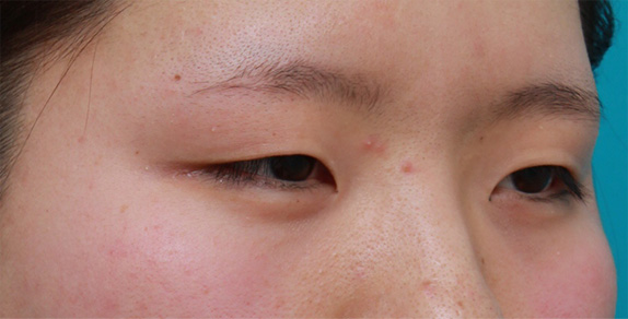症例写真,目頭切開+眼瞼下垂手術で小さい目を一回り大きくした症例写真,Before,ba_ganken46_b.jpg