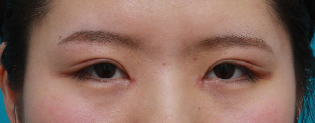 症例写真,目頭切開+眼瞼下垂手術で小さい目を一回り大きくした症例写真,1週間後,mainpic_ganken10c.jpg