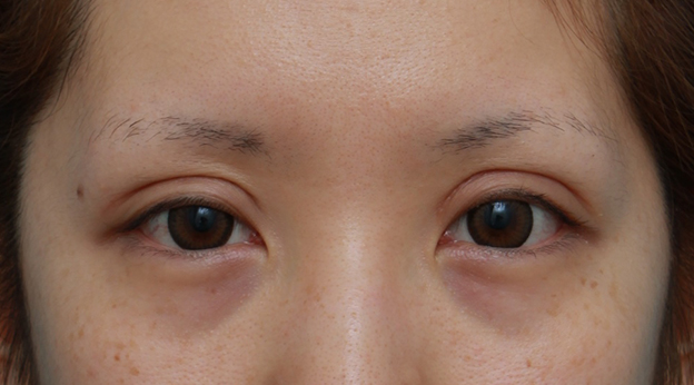 症例写真,他院で切開法で非常に幅の広い二重を作り失敗し、眼瞼下垂手術で幅を狭く修正した症例写真,1ヶ月後,mainpic_ganken11e.jpg