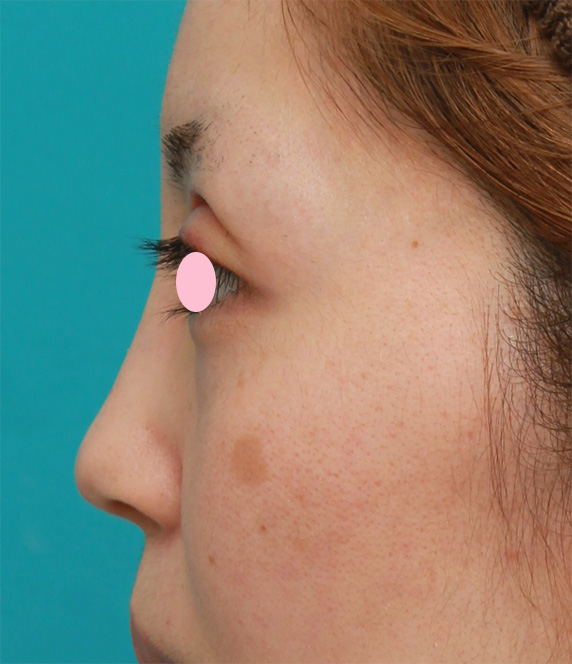 症例写真,鼻尖縮小+鼻先の耳介軟骨移植で、団子鼻をすっきりさせた症例写真,After（6ヶ月後）,ba_bisen26_b.jpg