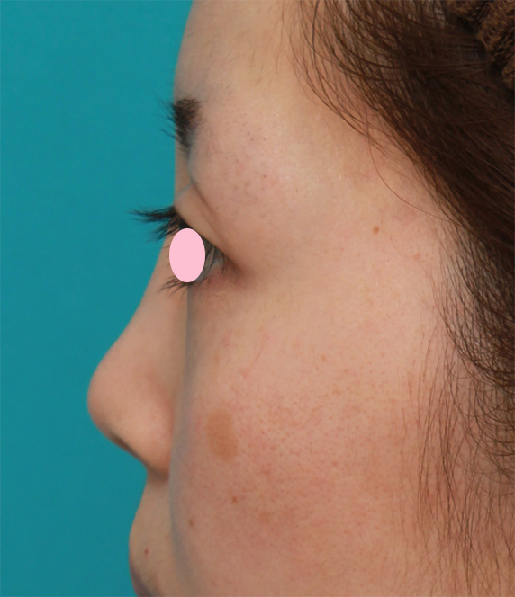 症例写真,鼻尖縮小+鼻先の耳介軟骨移植で、団子鼻をすっきりさせた症例写真,Before,ba_bisen26_b.jpg