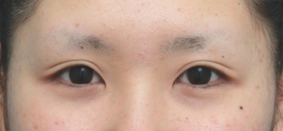 症例写真,眼瞼下垂手術で幅の広い平行型二重まぶたを作った症例写真の術前術後画像の解説,After,ba_ganken51_b.jpg