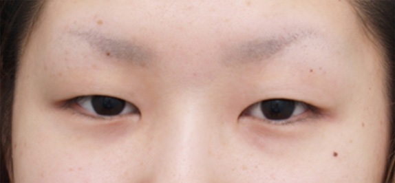 症例写真,眼瞼下垂手術で幅の広い平行型二重まぶたを作った症例写真の術前術後画像の解説,Before,ba_ganken51_b.jpg