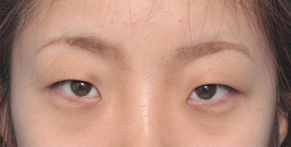 症例写真,目頭切開+眼瞼下垂手術で小さい目を大きくした症例写真,Before,ba_ganken52_b.jpg