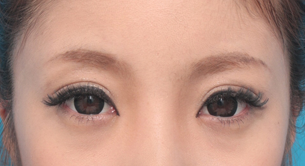 症例写真,目頭切開+眼瞼下垂手術で小さい目を大きくした症例写真,6ヶ月後,カラコン、メイクあり,mainpic_ganken12g.jpg