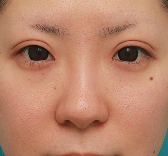 症例写真,鼻先の皮膚の厚いダンゴ鼻に、鼻尖縮小+耳介軟骨移植をした症例写真の術前術後画像,Before,ba_bisen27_b.jpg