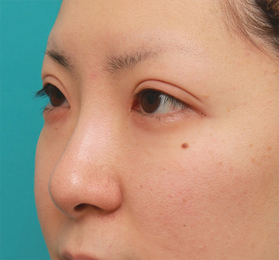 耳介軟骨移植（鼻先を出す）,鼻先の皮膚の厚いダンゴ鼻に、鼻尖縮小+耳介軟骨移植をした症例写真の術前術後画像,Before,ba_bisen28_b.jpg