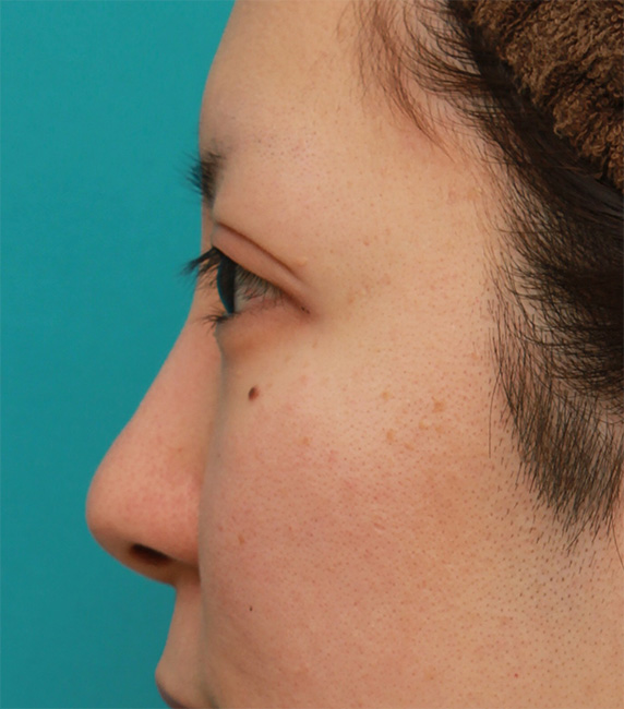 耳介軟骨移植（鼻先を出す）,鼻先の皮膚の厚いダンゴ鼻に、鼻尖縮小+耳介軟骨移植をした症例写真の術前術後画像,After（6ヶ月後）,ba_bisen29_b.jpg