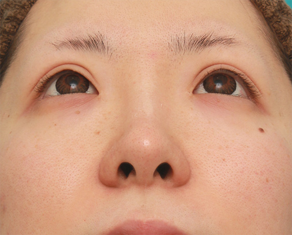 症例写真,鼻先の皮膚の厚いダンゴ鼻に、鼻尖縮小+耳介軟骨移植をした症例写真の術前術後画像,After（6ヶ月後）,ba_bisen30_b.jpg
