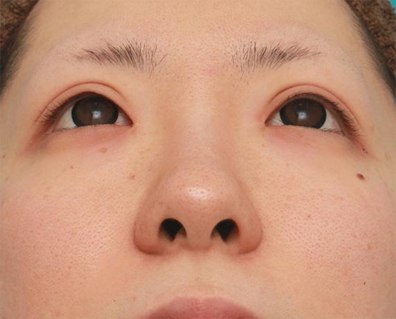 症例写真,鼻先の皮膚の厚いダンゴ鼻に、鼻尖縮小+耳介軟骨移植をした症例写真の術前術後画像,Before,ba_bisen30_b.jpg