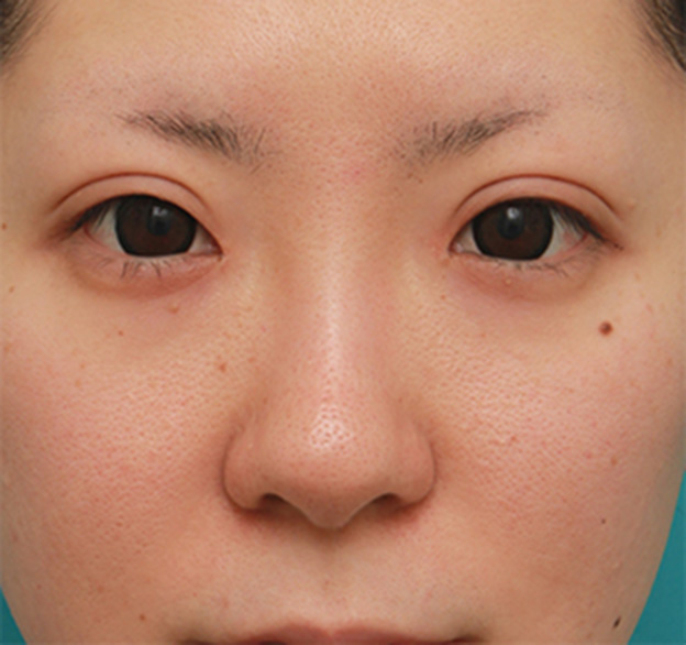 症例写真,鼻先の皮膚の厚いダンゴ鼻に、鼻尖縮小+耳介軟骨移植をした症例写真の術前術後画像,手術前,mainpic_bisen02a.jpg
