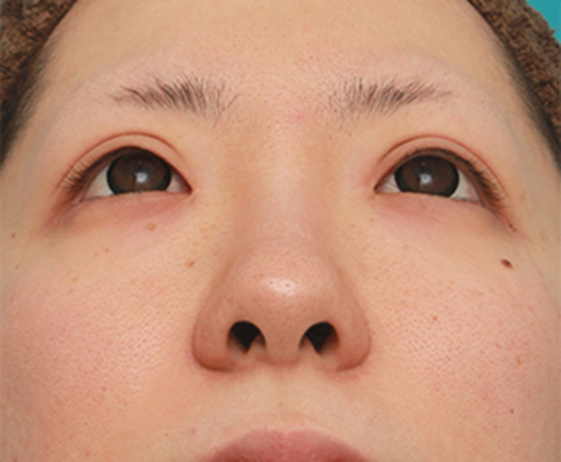 症例写真,鼻先の皮膚の厚いダンゴ鼻に、鼻尖縮小+耳介軟骨移植をした症例写真の術前術後画像,手術前,mainpic_bisen02f.jpg