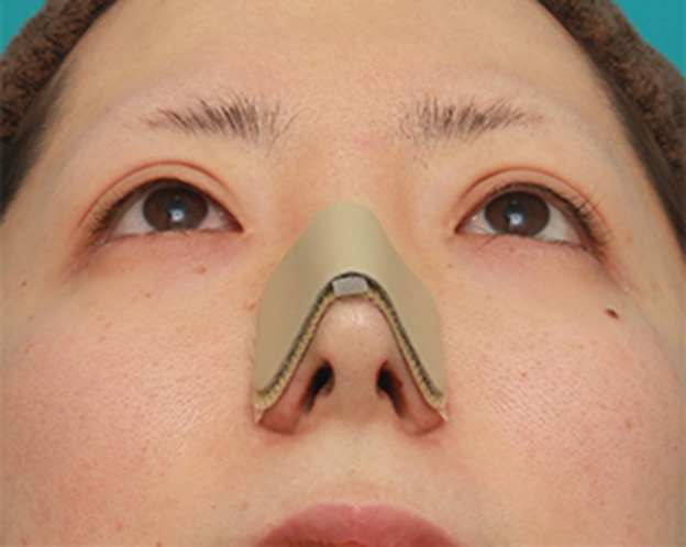 症例写真,鼻先の皮膚の厚いダンゴ鼻に、鼻尖縮小+耳介軟骨移植をした症例写真の術前術後画像,手術直後,mainpic_bisen02g.jpg