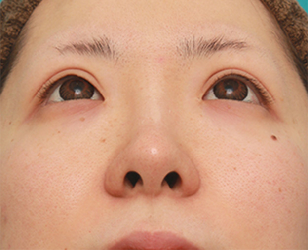 症例写真,鼻先の皮膚の厚いダンゴ鼻に、鼻尖縮小+耳介軟骨移植をした症例写真の術前術後画像,6ヶ月後,mainpic_bisen02h.jpg