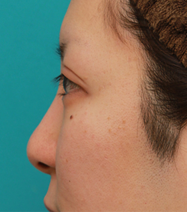 耳介軟骨移植（鼻先を出す）,鼻先の皮膚の厚いダンゴ鼻に、鼻尖縮小+耳介軟骨移植をした症例写真の術前術後画像,手術前,mainpic_bisen02k.jpg