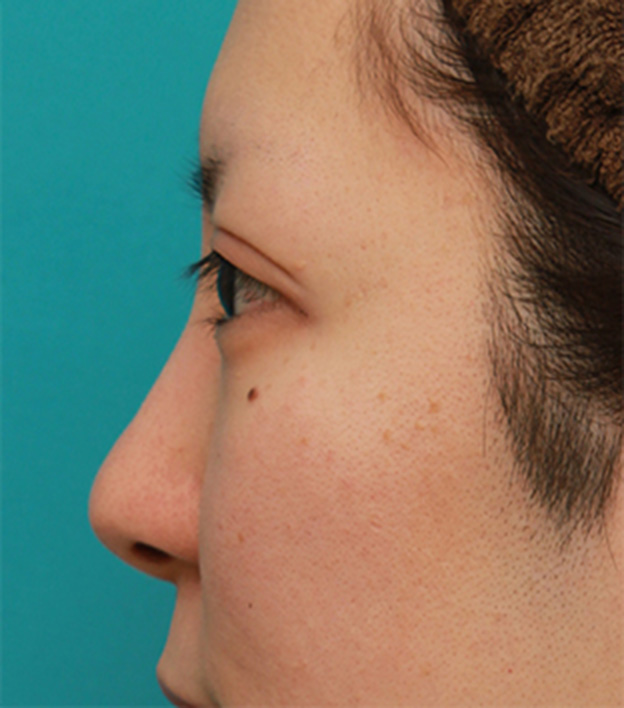 耳介軟骨移植（鼻先を出す）,鼻先の皮膚の厚いダンゴ鼻に、鼻尖縮小+耳介軟骨移植をした症例写真の術前術後画像,6ヶ月後,mainpic_bisen02l.jpg