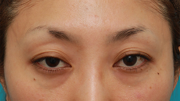 症例写真,開きに左右差がある眼瞼下垂を手術で修正した30代女性の症例写真,Before,ba_ganken53_b.jpg