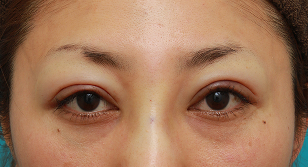 症例写真,開きに左右差がある眼瞼下垂を手術で修正した30代女性の症例写真,手術直後 ,mainpic_ganken13b.jpg