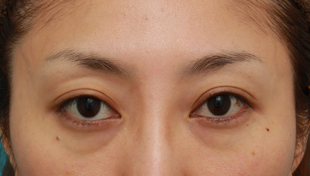 症例写真,開きに左右差がある眼瞼下垂を手術で修正した30代女性の症例写真,4ヶ月後,mainpic_ganken13e.jpg