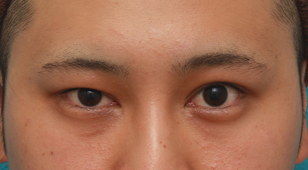 症例写真,片目の眼瞼下垂を手術で治し、ほぼ左右対称にした症例写真,手術前,mainpic_ganken14a.jpg