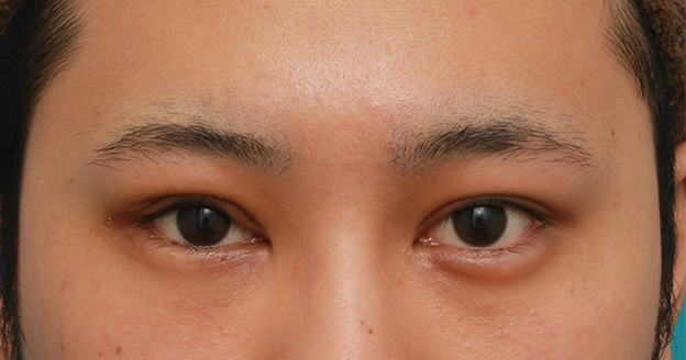 症例写真,片目の眼瞼下垂を手術で治し、ほぼ左右対称にした症例写真,1週間後,mainpic_ganken14c.jpg