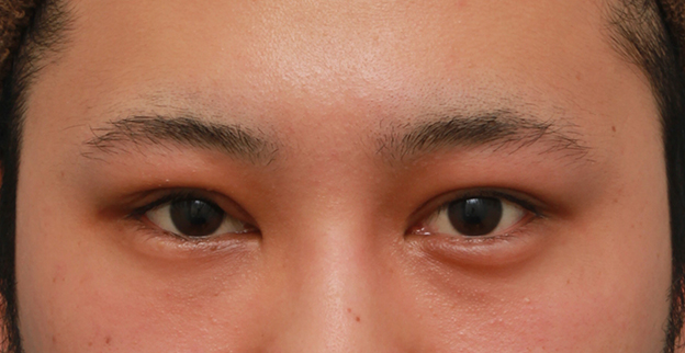 症例写真,片目の眼瞼下垂を手術で治し、ほぼ左右対称にした症例写真,1ヶ月後,mainpic_ganken14d.jpg
