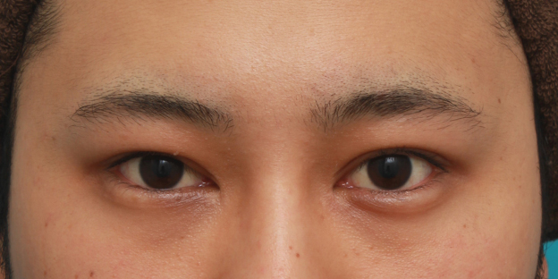 症例写真,片目の眼瞼下垂を手術で治し、ほぼ左右対称にした症例写真,3ヶ月後,mainpic_ganken14e.jpg