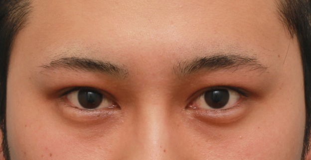 症例写真,片目の眼瞼下垂を手術で治し、ほぼ左右対称にした症例写真,8ヶ月後,mainpic_ganken14f.jpg