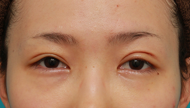症例写真,先天性と思われる片目の眼瞼下垂を修正し、反対の目は二重まぶた全切開法をした症例写真の術前術後画像,1週間後,目を開けた状態,n1elc60000002mje.jpg