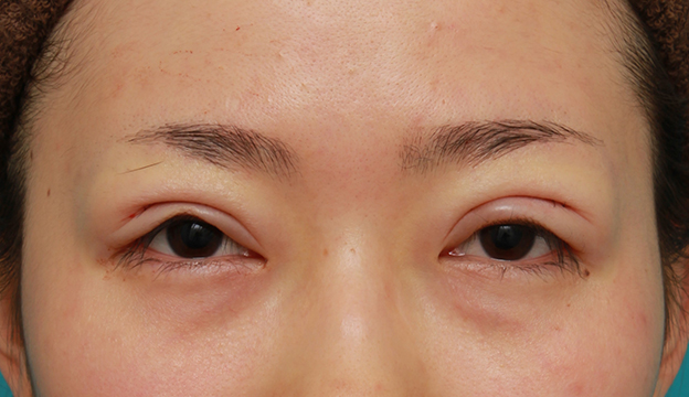 症例写真,先天性と思われる片目の眼瞼下垂を修正し、反対の目は二重まぶた全切開法をした症例写真の術前術後画像,手術直後,目を開けた状態,n1elc60000002mju.jpg