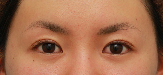 症例写真,眼瞼下垂手術で眠たそうなまぶたの開きを良くし、同時に一重を二重にした20代女性の症例写真の術前術後画像,After（6ヶ月後）,ba_ganken56_b.jpg