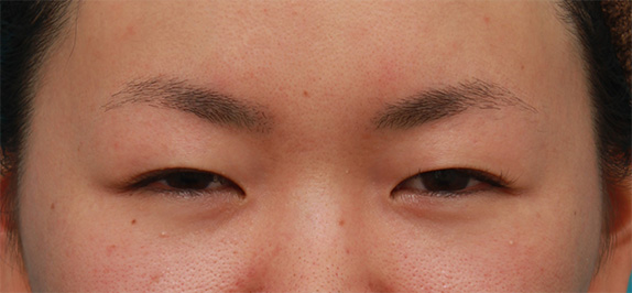 症例写真,眼瞼下垂手術で眠たそうなまぶたの開きを良くし、同時に一重を二重にした20代女性の症例写真の術前術後画像,Before,ba_ganken56_b.jpg