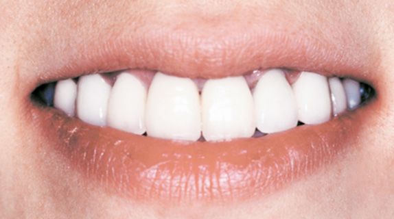 オールセラミッククラウン（e-max）の症例写真 前側6本の歯並びとバランス調整,After,ba_ceramic03_a01.jpg