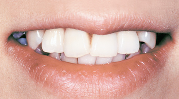 オールセラミッククラウン（e-max）の症例写真 前側6本の歯並びとバランス調整,Before,ba_ceramic03_b.jpg