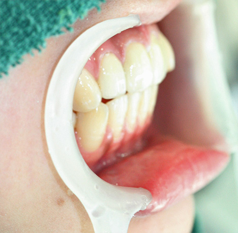 症例写真,オールセラミッククラウン（e-max）の症例写真 上顎前歯の出っ歯の修正,After,ba_ceramic14_b.jpg