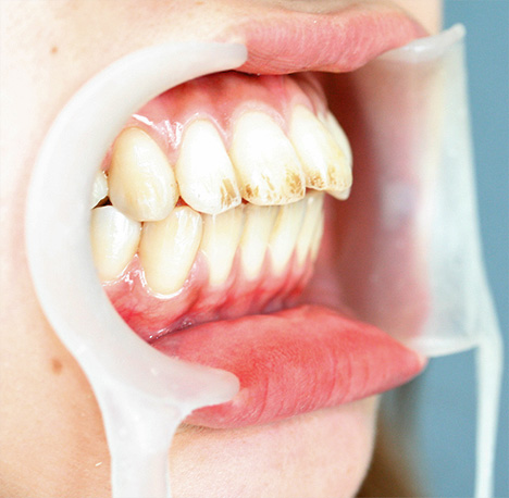 症例写真,オールセラミッククラウン（e-max）の症例写真 上顎前歯の出っ歯の修正,Before,ba_ceramic14_b.jpg
