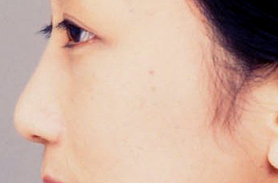 症例写真,わし鼻・段鼻修正、ハンプ切除 鼻の根元が広がり目立っていた30代女性の症例,After,ba_hump14_b.jpg